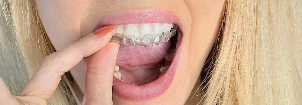 Top 5 Reasons to Consider Invisalign as an Adult
